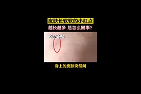 皮肤突然长很多软软的小红点，是怎么回事呢？会影响健康吗？#健康科普 #皮肤 #涨知识 视频封面