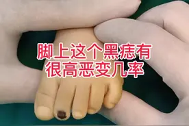 指甲上的黑痣，有很高恶变几率，尤其是快速变化时，尽早手术，医生网上摆摊咯！传播健康😘#健康中国 #摆摊生活