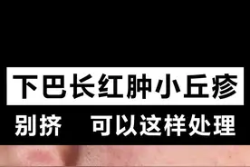 下巴长红肿小丘疹，别挤，试试这样做#痘痘 #皮肤 视频封面