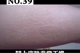 皮肤干燥像鱼鳞一样是什么原因？怎么办呢？#皮肤 #鱼鳞病 视频封面
