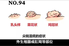私密部位长菜花一样的小肉粒，这可能是#尖锐湿疣 真的那么可怕吗#医学科普 #皮肤 视频封面