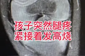 孩子持续腿疼，还发烧，千万要提防急性骨髓炎，前期检查不明显，拍x光不一定能发现#抗击疫情 #健康中国2030