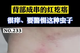 #健康科普背部出现成串的红色风团疙瘩，瘙痒难耐，要警惕这类虫子。#被虫子咬了#跳蚤 视频封面