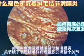 腱鞘巨细胞瘤在关节内又被称为色素沉着绒毛结节性滑膜炎视频封面