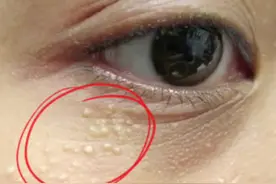 #脂肪粒 又叫#粟丘疹 可以试一下这个祛除方法！视频封面