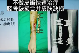 胫骨骨外露的治疗#医学科普 #医者仁心 #只有经历过的人才会懂视频封面