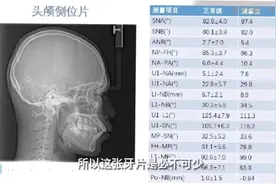 #牙齿矫正为什么要先拍牙片？了解到很多牙友有疑惑：去