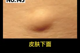 皮肤下面出现小肿块，有弹性，轻轻推还有轻微移动#脂肪瘤 #皮肤 #涨知识 视频封面