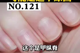 指甲出现竖纹，是有什么大病吗？#皮肤 #指甲 #科普视频封面