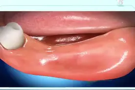 缺牙太久，牙槽骨萎缩怎么做种植牙呢？种牙植骨了解一下#dou出新知 #郑州