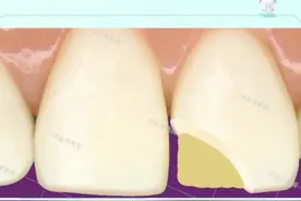 意外把门牙磕掉了一块，不要害怕，可以补起来哦！一起来看看怎么补的吧！#郑州 #知识创作人 #dou出新视频封面