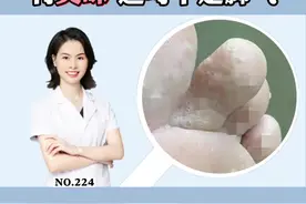 #脚臭 的很，还有小洞洞，这可不是#脚气 #科普视频封面