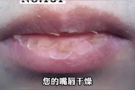 嘴唇特别干燥，总是撕唇皮，有时候还会有裂口，可能是#唇炎 #皮肤 视频封面
