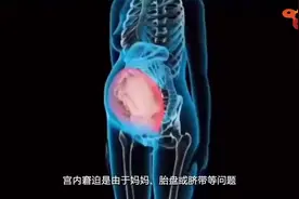 有关宝宝"宫内窘迫"，你了解多少。#医学科普 #胎宝宝 #孕育