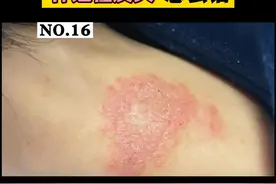 脖子，手肘越抓越痒，皮疹还越来越厚，这可能是#神经性皮炎 教你一个小妙招来缓解#科普 #瘙痒 视频封面