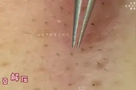 拔毳毛（上）#毳毛 #闭口 #挤痘痘 #解压挤痘痘 #毛囊清洁视频封面
