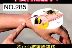 被蜜蜂蜇伤，科学处理很重要，别再泡醋了！#蜜蜂 #医学科普 #健康科普 #科普 #涨知识 视频封面