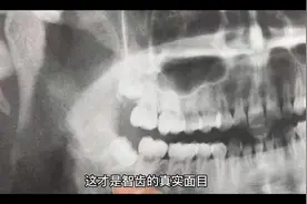 【智齿】的真实面目！对它仁慈就是对自己残忍！视频封面