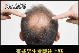 男生发际线后移呈m型，呈地中海，不一定要植发，可以试试这么做#头发 #秃头 视频封面
