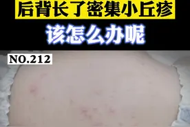 出汗时，后背的小丘疹瘙痒，灼热，不要搔抓，可以这样处理。#后背长痘 视频封面