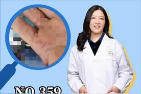 #皮肤健康手掌起硬皮，有裂口，到了冬天疼痛难忍，#鹅掌风 可以这样处理。#手癣 #手脚干裂 视频封面