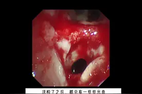 年轻人的咳嗽，咳血需要警惕！#医学科普 #医学常识 #医学影像视频封面