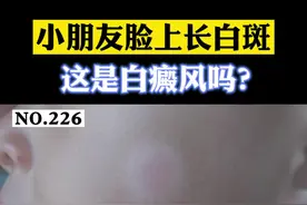 小朋友脸上长了白斑，家长容易误认为是#白癫风 ，其实这是#白色糠疹 ，一般情况下会慢慢消退，不用太担心。#科普 视频封面