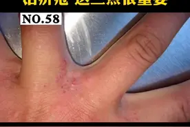一到晚上就浑身痒的难受，身上还出现了很多小疹子，治疗#疥疮 这三点至关重要#医学科普 视频封面