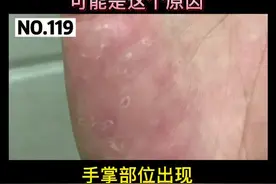 手掌反复脱皮，有时候还会多汗，可能是这个原因#科普 #手视频封面