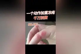 冬天你的一个不经意的动作可能会导致发冻疮或让冻疮更严重，一定要注意避免，特别是老人和小朋友！#冻疮 #手脚冰凉 #皮肤 #健康科普 视频封面