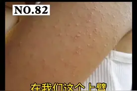 手臂像#鸡皮肤 ，太难看了，怎么办？可以这么处理。#皮肤 #医学科普视频封面