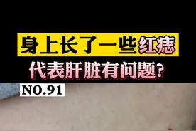 身上长凸起的小#红痣 ，就代表肝脏不好或者是#健康 有问题吗？#樱桃状血管瘤 #朱砂痣 #医学科普 视频封面