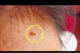 脸上和脖子上长了一颗颗小肉粒，不要去揪，皮肤科医生教你处理方法#医学科普 #皮肤科 #丝状疣视频封面