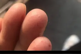 手上起透明小水泡，特别痒，怎么办？#汗疱疹 #科普 @抖音短视频 视频封面