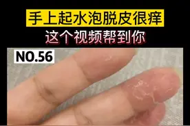 手上起水泡，脱皮很痒，手部#湿疹 应该怎么办，这个视频帮到你#科普