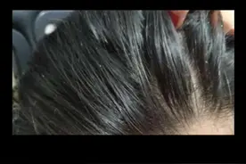 头发上的油是怎么产生的？ #科普 #头油 #图文成片打卡挑战视频封面