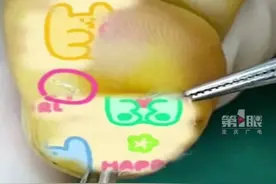 手机膜碎要警惕！#女子被钢化膜碎片扎手后长出瘤。#广西