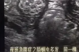 #孩子 肚子里有虫？教你不花钱判断#蛔虫 视频封面