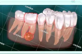 牙根脓肿，为什么要通过根管治疗才行，看完你知道原因了吗？#口腔科普 #医学科普 #dou出新知 #牙齿健康视频封面