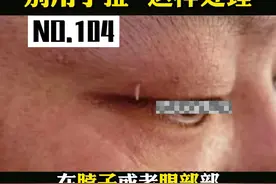 这种细细的小肉条，不要用手，或者剪D，危险还不断根，我们可以这样处理#丝状疣 #疣 #hpv #皮肤 视频封面