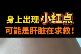#皮肤 注意了，身上忽然长了一些#痣 或#小红点 ，很可能是某些疾病的伪装！#知识创作人 #健康视频封面