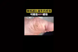 脚底长了这种粗疙瘩，这可不是#鸡眼 可能是#HPV 感染引起的#跖疣 #科普 