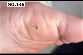 脚底长了这种粗疙瘩，这可不是#鸡眼 可能是#HPV 感染引起的#跖疣 #科普 视频封面