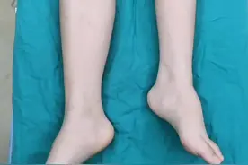 孩子走路一瘸一拐，双腿不一样长，不一样粗细，一定要注意是否#脊柱侧弯 ， 同样脊柱侧弯也要看下肢是否不一样长视频封面