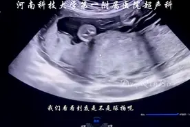 #超声影像 #即兴讲解#脐带#每天学习一点点 #医路有你 #医路前行视频封面