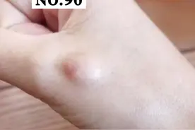 脂肪瘤需要治疗吗？瘦也会长吗？#脂肪瘤 #医学科谱 视频封面