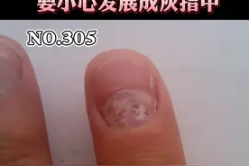 指甲月牙处发白，逐渐扩散蔓延，要小心这种情况#灰指甲 #指甲 #健康科普 视频封面