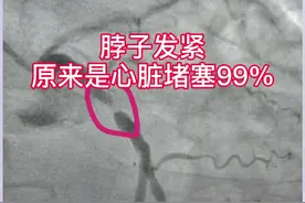 脖子发紧    原来是心脏堵塞99% @太医管家 #科普健康中国视频封面