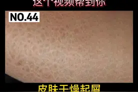 皮肤干燥起屑脱皮，像鱼鳞一样，应该怎么办，可以这样处理#鱼鳞病 #科普视频封面