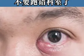 眼周长了红肿疙瘩，不要再傻傻的跑错了科室#睑腺炎 #眼科#眼皮肿 #皮肤 #医学科普 视频封面